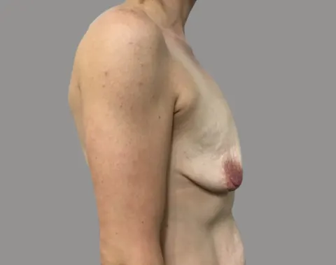 Breast augmentation before right side view, case 72