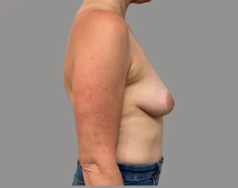 Breast augmentation before left side view, case 73