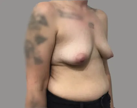 Breast augmentation before right oblique view, case 74