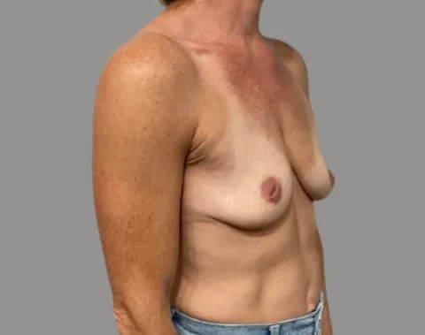Breast augmentation with lift before right oblique view, case 33
