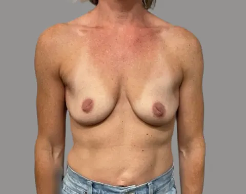 Breast augmentation with lift before front view, case 33