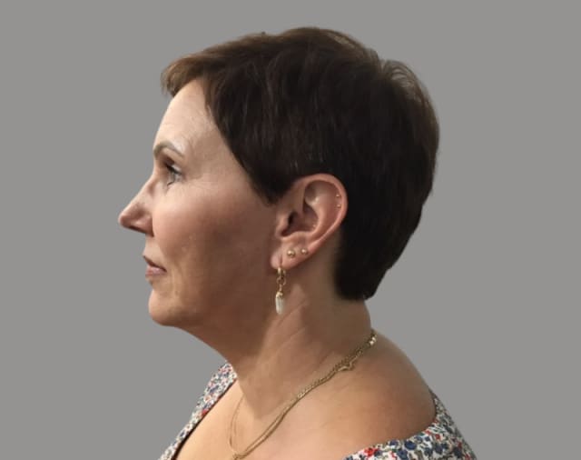 Facelift After