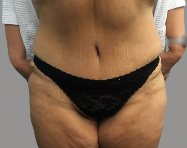 Tummy Tuck After