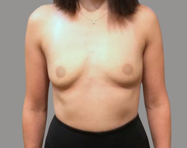 Breast Augmentation Before