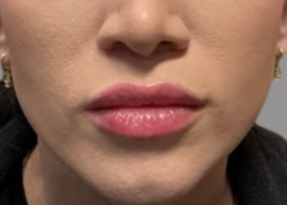 Lip enhancement before front view, case 01