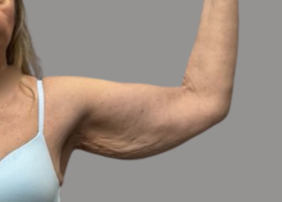 Arm lift before front view, case 01
