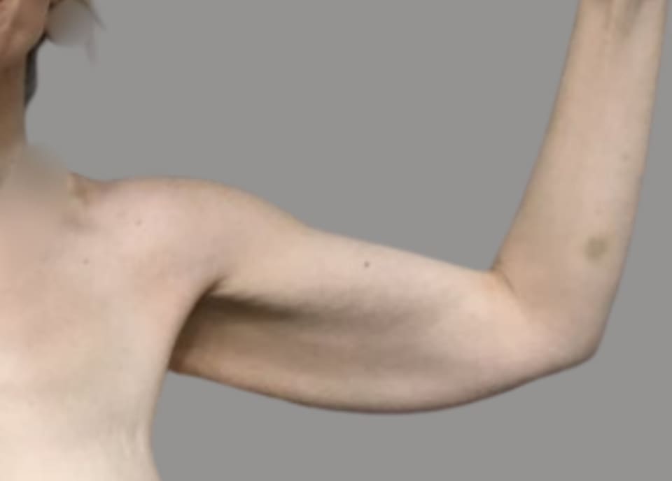 Arm lift before front view, case 02