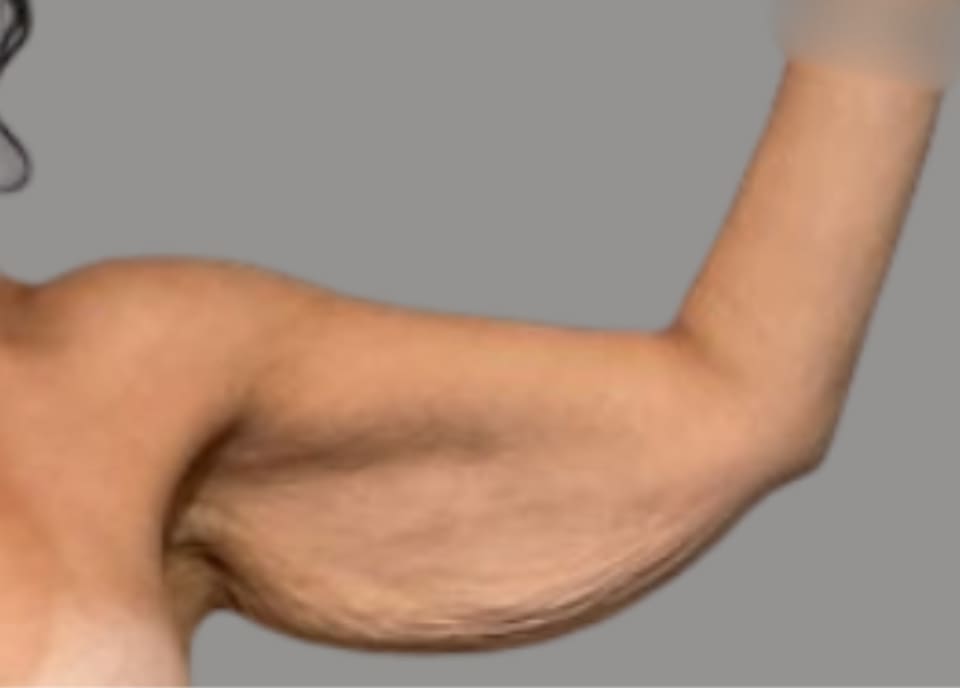 Arm lift before front view, case 03
