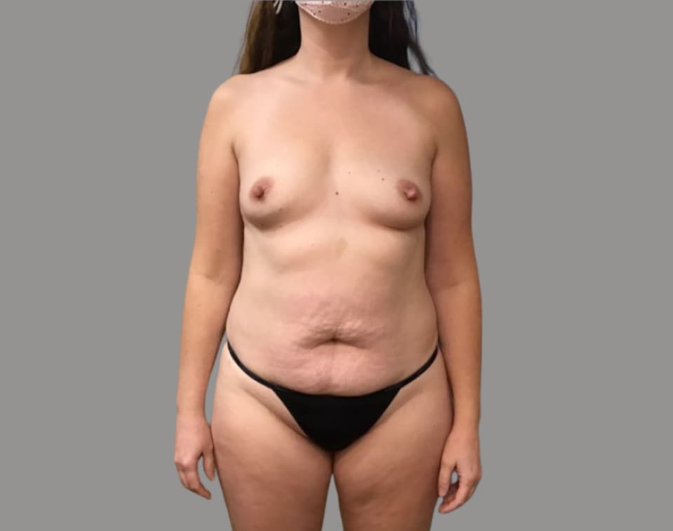 Mommy makeover before front view, case 03