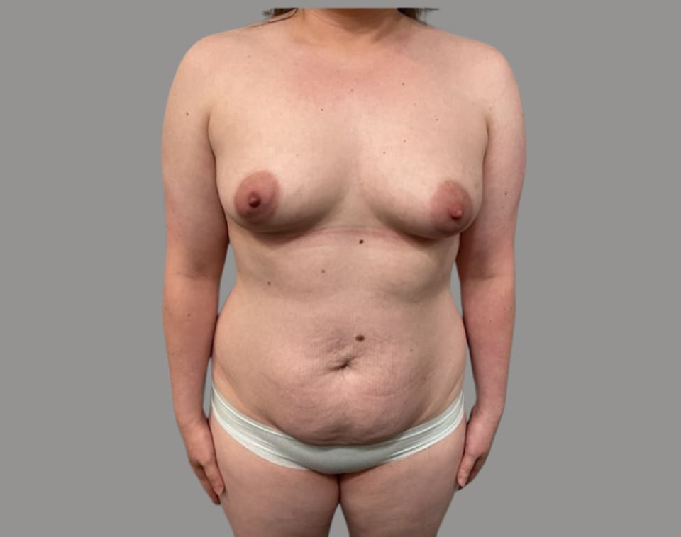 Mommy makeover before front view, case 01