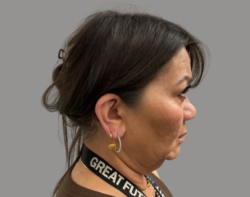 Facelift before right side view, case 08