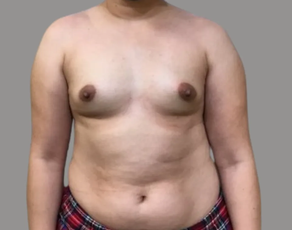 Breast augmentation before front view, case 65