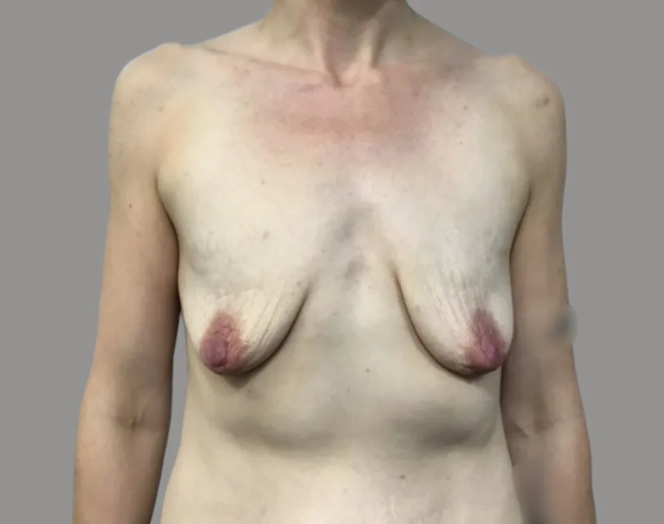Breast augmentation before front view, case 72