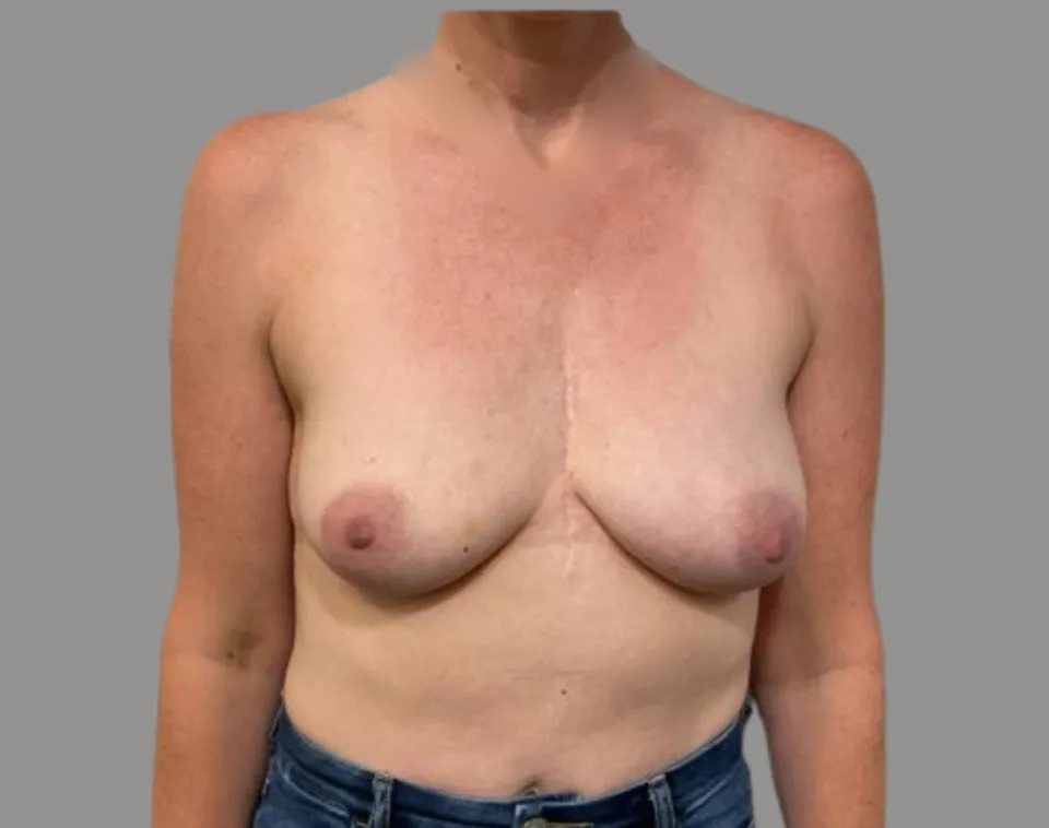 Breast augmentation before front view, case 73