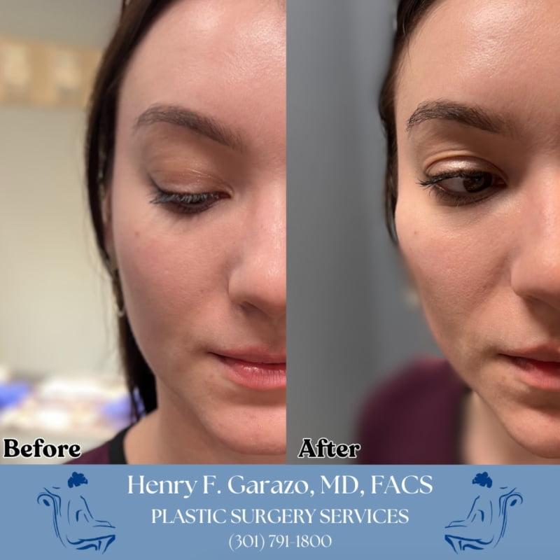 Before and after cheek filler with Juvederm Voluma injections by Dr. Garazo