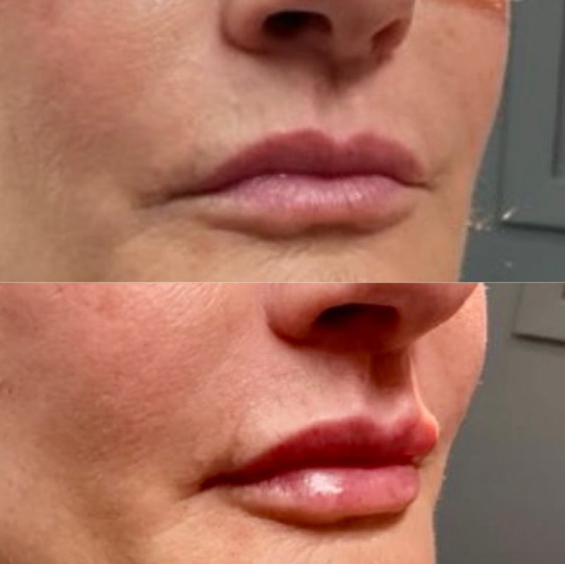 Before and after lip filler injections by Dr. Garazo