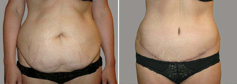 Before and after tummy tuck with Dr. Henry Garazo