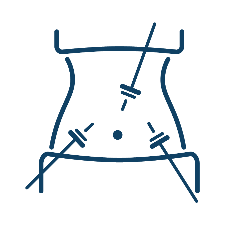 Laparoscopy