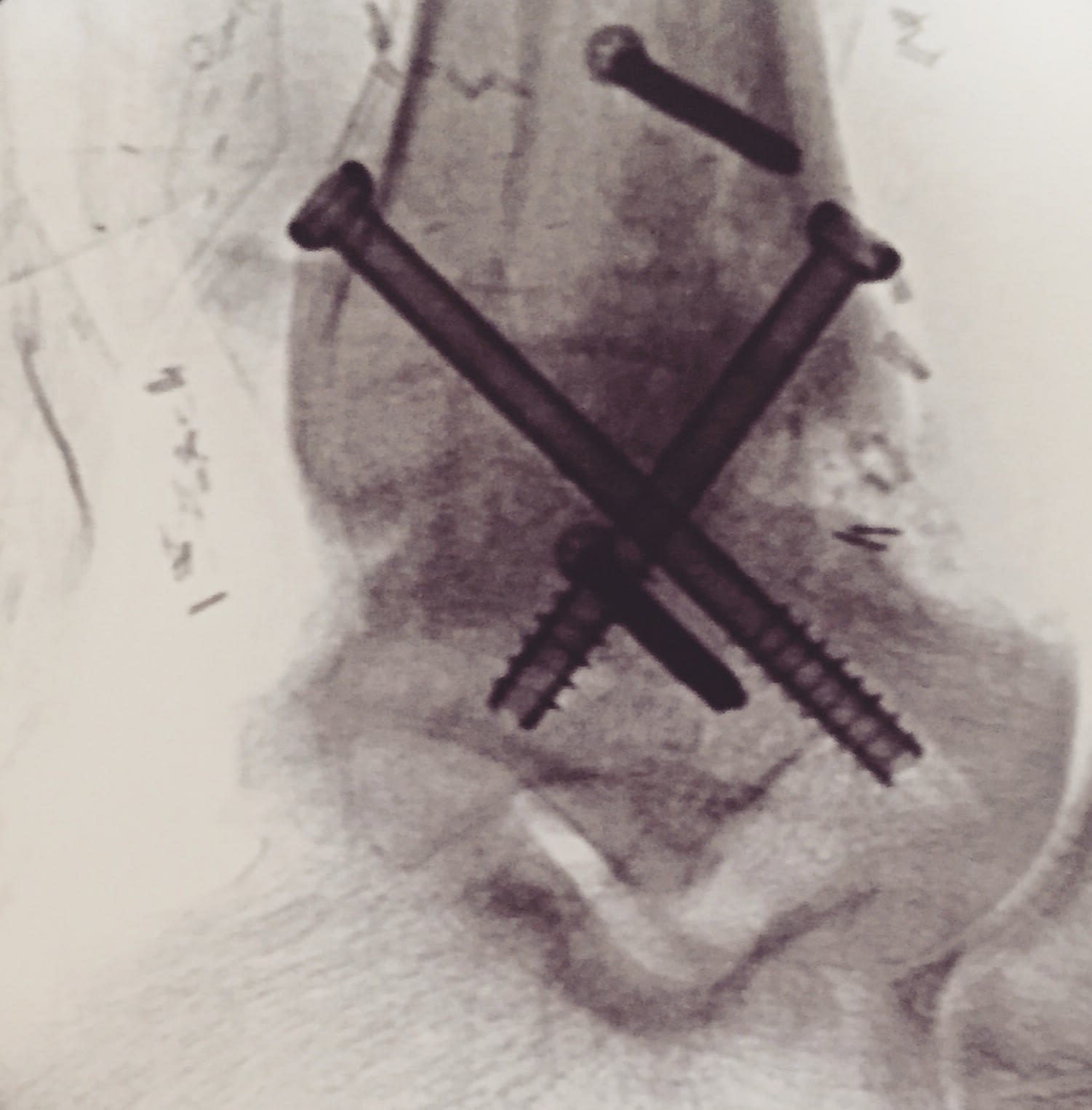 An x-ray of my left ankle showing the tibiotalar fusion_with four screws at varying angles to hold my tibia and talus together in a fixed position.