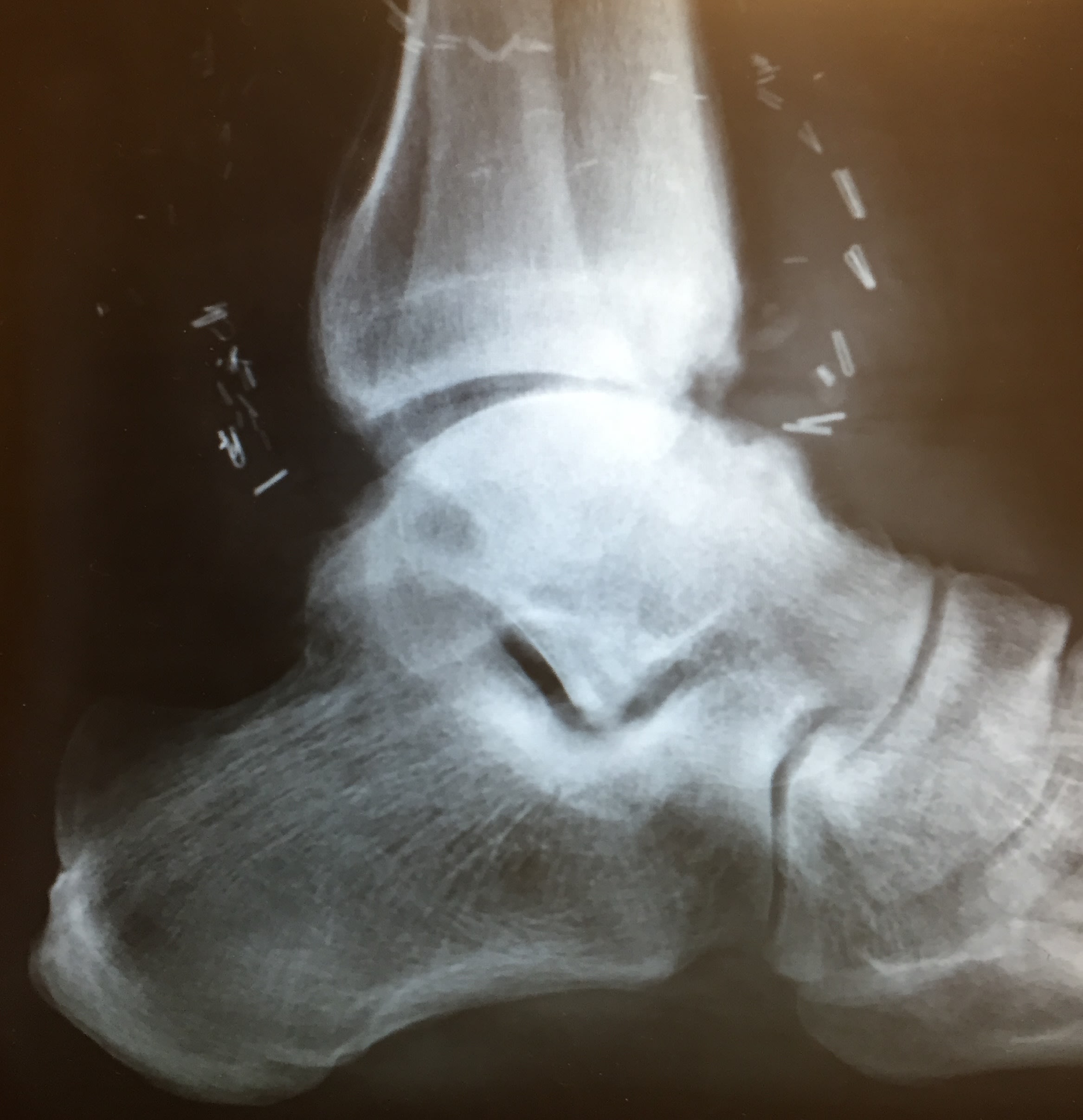 An x-ray of my left ankle showing the tibia further back over my ankle than it should be and significant degredation of the front of both the tibia and talus.