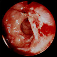 Photos of Crohn's disease of the colon taken at colonoscopy