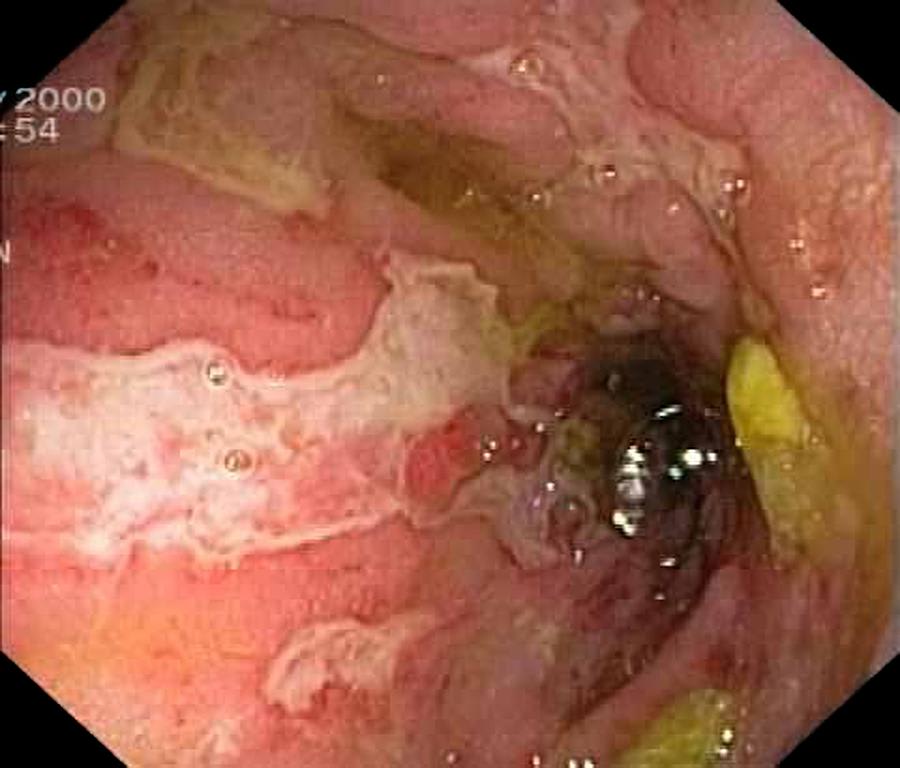 Colonic Crohn's disease - as seen at colonoscopy