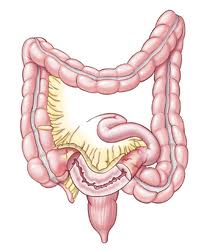 The main common site for Crohn's diseae is the terminal ileum - that is the last part of the small bowel before it joins the large bowel