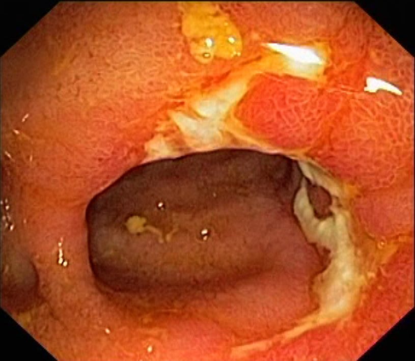 Endoscopic image  - terminal ileum with ulceration and swelling resulting in narrowing of the lumen