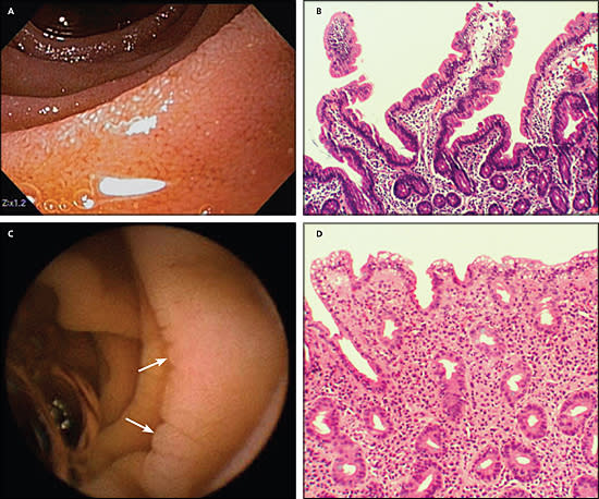 Coeliac disease.  The top 2 photos show a normal small bowel and the bottom 2 photos show coeliac disease - with loss of villi
