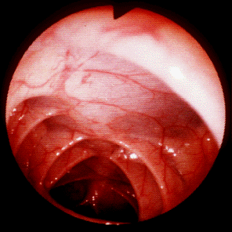 Normal colon - no inflammation