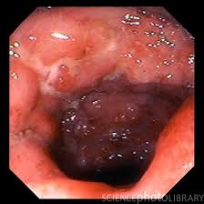 Crohn's disease involving the colon.  There is deeper swelling and larger ulcers