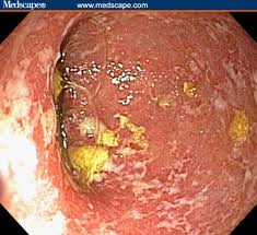 Ulcerative colitis