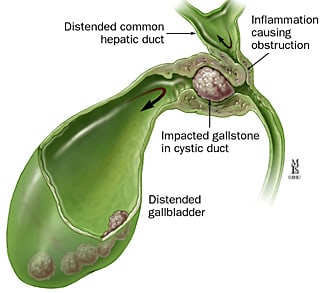 Gallstone has logged in the duct connecting the gallbaldder to the main bile duct.  This is cause severe pain known as biliary colic