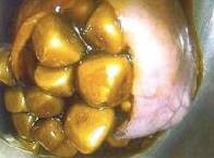 Gallstones