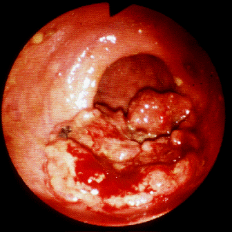 Cancer of the colon.  This started as a polyp but has become larger and more irregular - now with  more rapid and uncontrolled growth