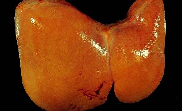 Yellow appearance of a liver with excess fat