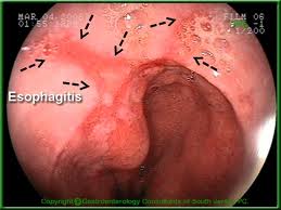 Reflux oesophagitis  - ulcers due to reflux