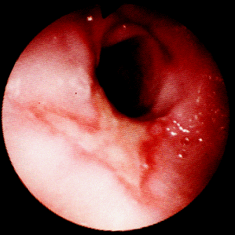 An area of ulceration at the junction between the oesophagus and the stomach