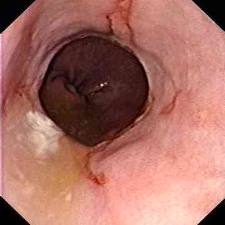 Reflux oesophagitis  - ulcers due to reflux