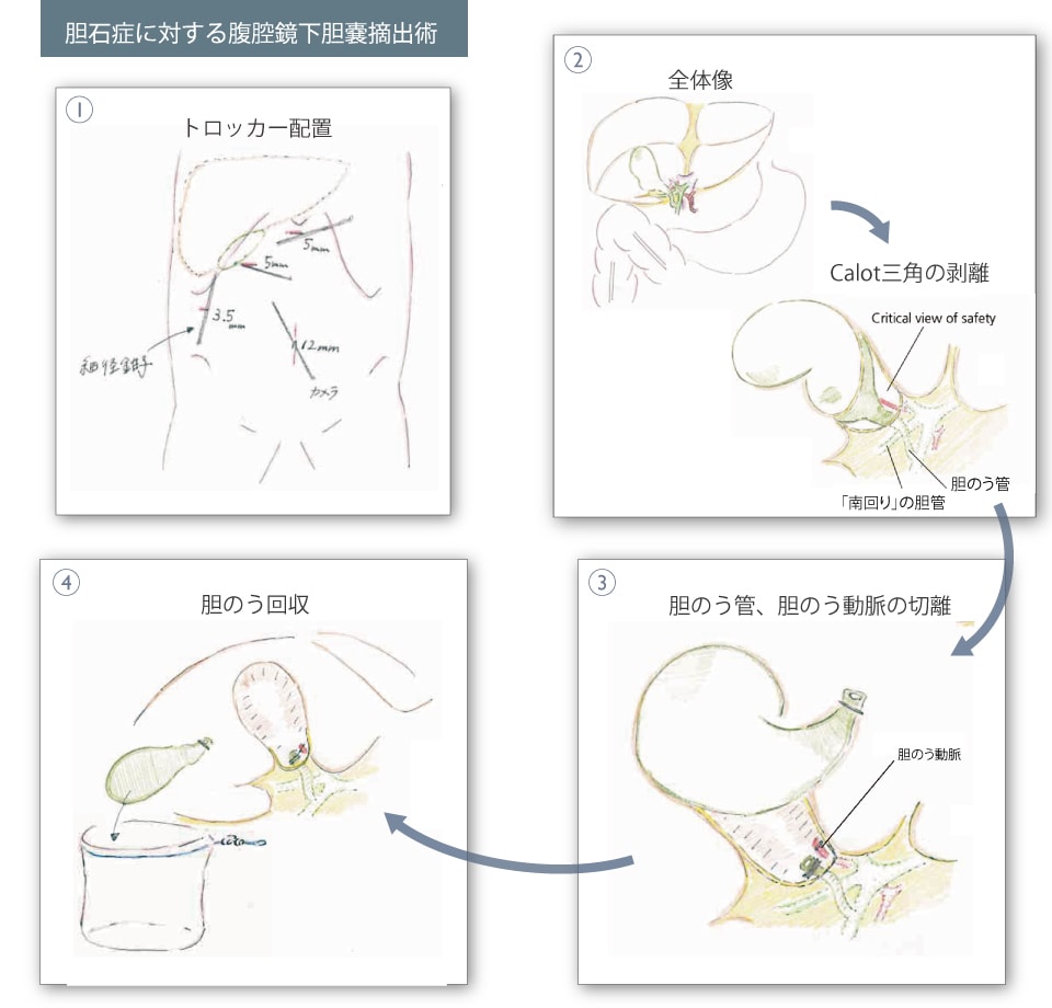 激痛が襲う「胆石症」…誰も知らない世界「手術室の中」で