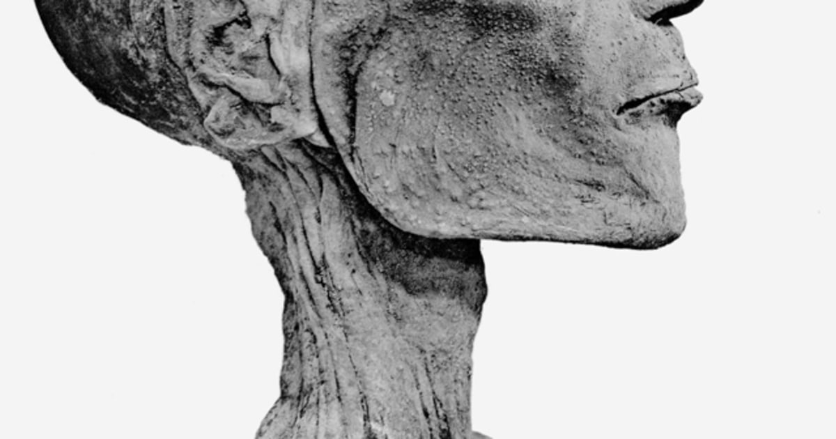 古代エジプト王のミイラの顔にも痕跡が…天然痘ウイルスがひき起こし