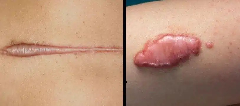 Chéloïdes : ce qu’il faut savoir sur ces cicatrices anormales