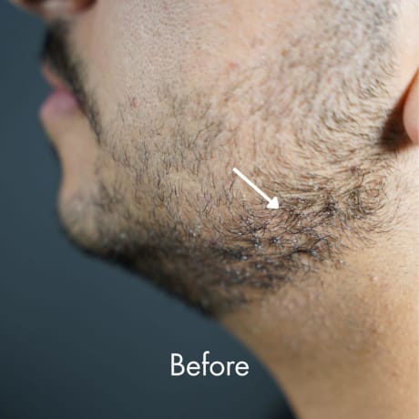 MAN-UP Beard Filler