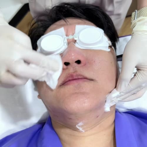 Mustache Laser Hair Removal at Apex, Central Eastville รูปที่ 1