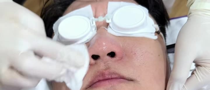 Mustache Laser Hair Removal at Apex, Central Eastville