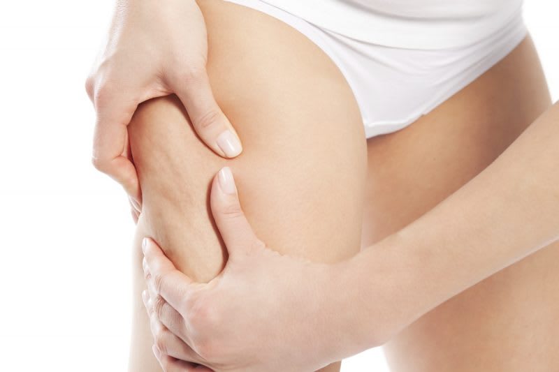 How to reduce cellulite with mesotherapy
