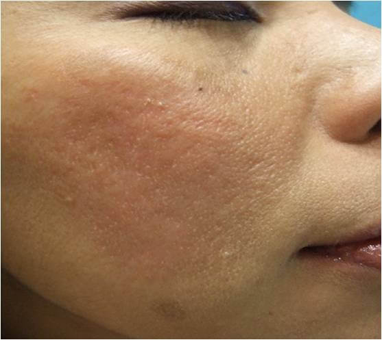 acne scars after needling treatment