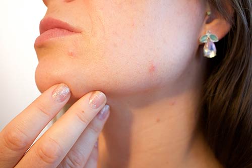 acne scars remedy