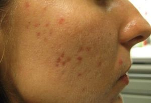 Example of acne scars