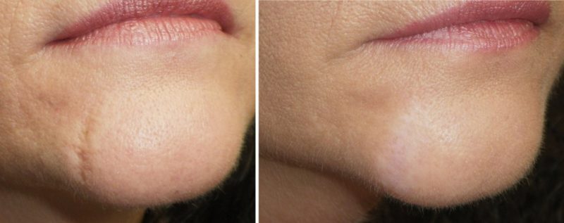Facial scar, on the chin